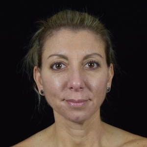 Midface, chin, marionette lines, nasolabial folds-after