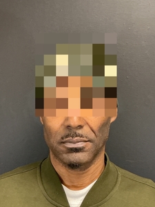 Before and after for nasolabial folds. #ultra-before