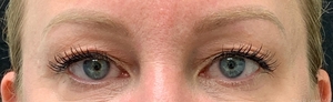 1 month post op upper blepharoplasty-before