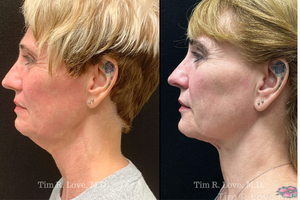 2 months post op MyEllevate, Facetite, and Morpheus8-before