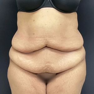 Tummy Tuck #16-before