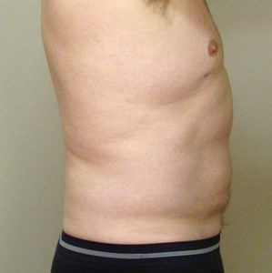 Liposuction #3-after