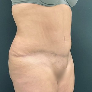 Tummy Tuck #13-after