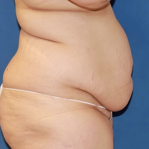 Tummy Tuck #9 (right)-before