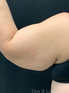 Brachioplasty-before