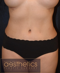 Tummy Tuck + Lipo-after