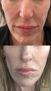 One XERF Treatment-before