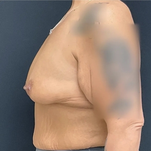 Breast Lift #14-before