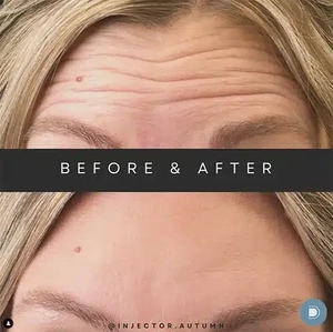 Botox-before