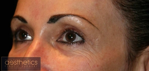 Upper & Lower plus Fat Graft-after