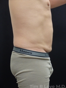 Abdominoplasty - Mini-before