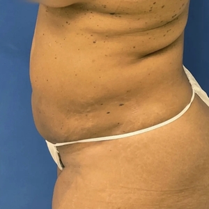 Lipo w Renuvion #6-after