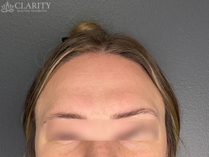 Daxxify: Frontalis-before