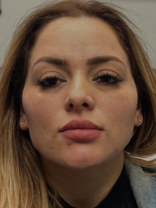 jawline filler-after