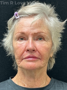 1 year post op short scar face lift and upper lip lift, MyEllevate, Facetite, Morpheus8 x2, Sculptra x4 vials, 1 syringe of Restylane Kysse in lips-after