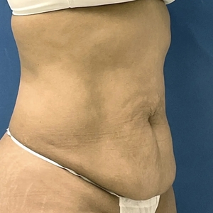 Tummy Tuck #3 (right oblique)-before
