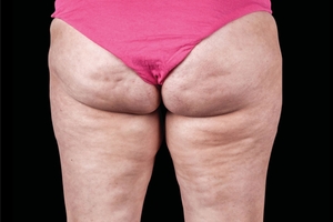 4 Treatments-before