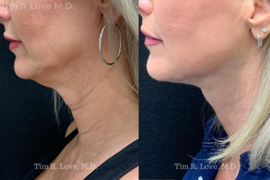 1 month post op MyEllevate, Morpheus8, and Sculptra x2 Vials-before