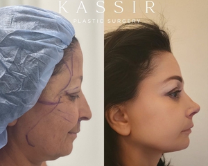 Before & After Designer Face and Neck Lift by Dr. Kassir-after