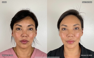 Even & Correct Advanced Brightening Treatment-before