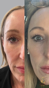 One XERF Treatment-before