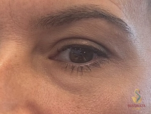Nouvaderm Laser Treatment- Lower Eye-24 hours Post Treatment-after