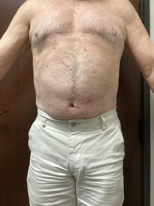 4 Abdomen + 4 Edge. 4 weeks after last treatment.-before