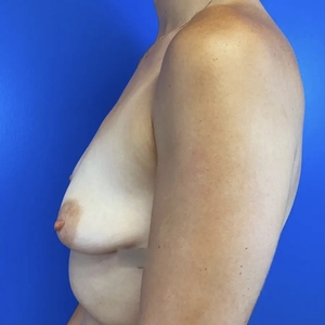 Breast Augmentation #1 355 cc-before