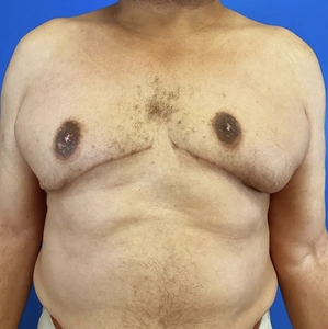 Male Breast Reduction #2-after
