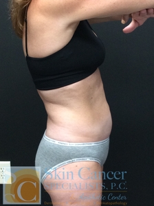 1 Treatment of Coolsculpting-after