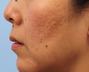 Post Acne Scars-after