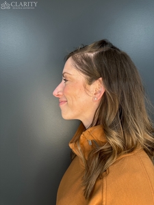 crow's feet (left)-before