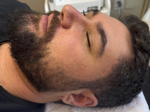 Michael B&A SkinPen-after