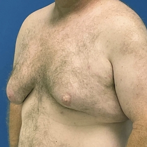 Male Breast Reduction #3-before