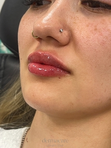 Danielle Glass RN. - Versa-after