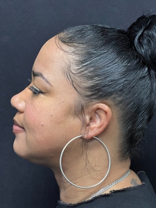 Submental Lipo + Thermitight-before