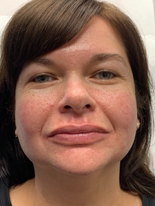 Lip Filler Versa-after