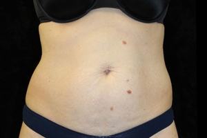 4 Treatments-after