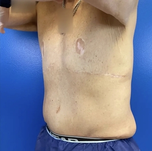 Male Breast Reduction #6-after