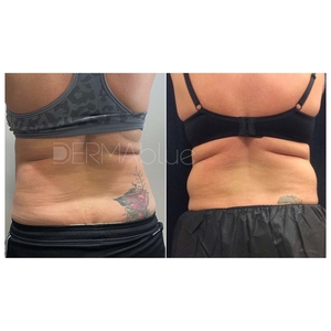 CoolSculpting - 2 Cycles-before