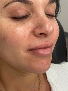 Whitney Devall RN.-before