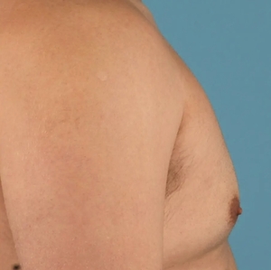 Male Breast Reduction #12 (right)-after