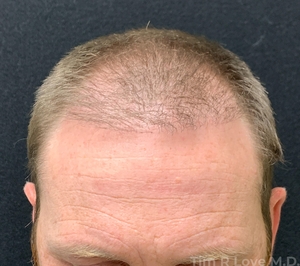 3600 grafts done in 2 sessions over a 5 year period-before