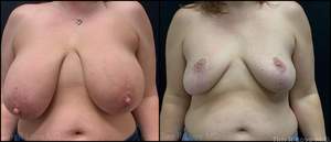 5'2 160lb 1 months post op breast reduction-before