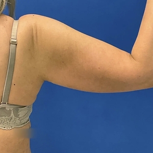 Lipo w Renuvion #11-before