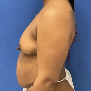 Mommy Makeover #2-before