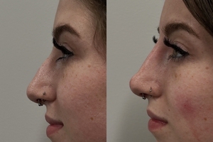Liquid Rhinoplasty-before
