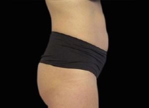 Emsculpt NEO #7-before