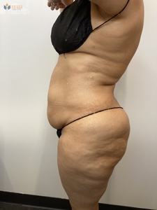 After 1 instasculpt treatment-after