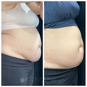 CoolSculpting-before